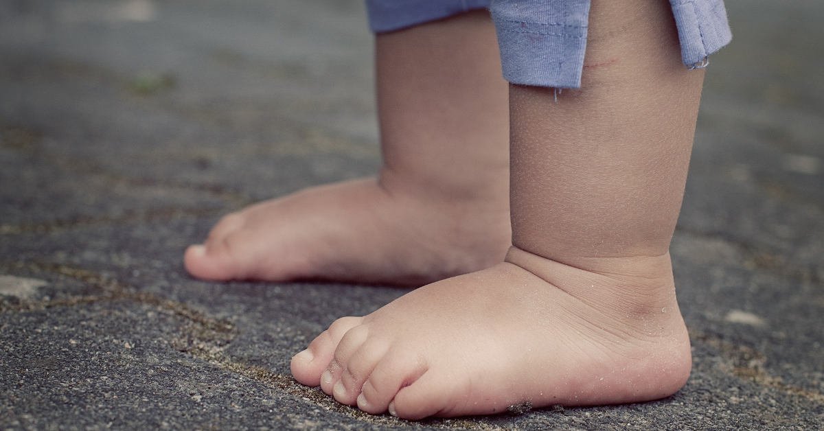 Các dị tật bàn chân thường gặp ở trẻ sơ sinh | Vinmec